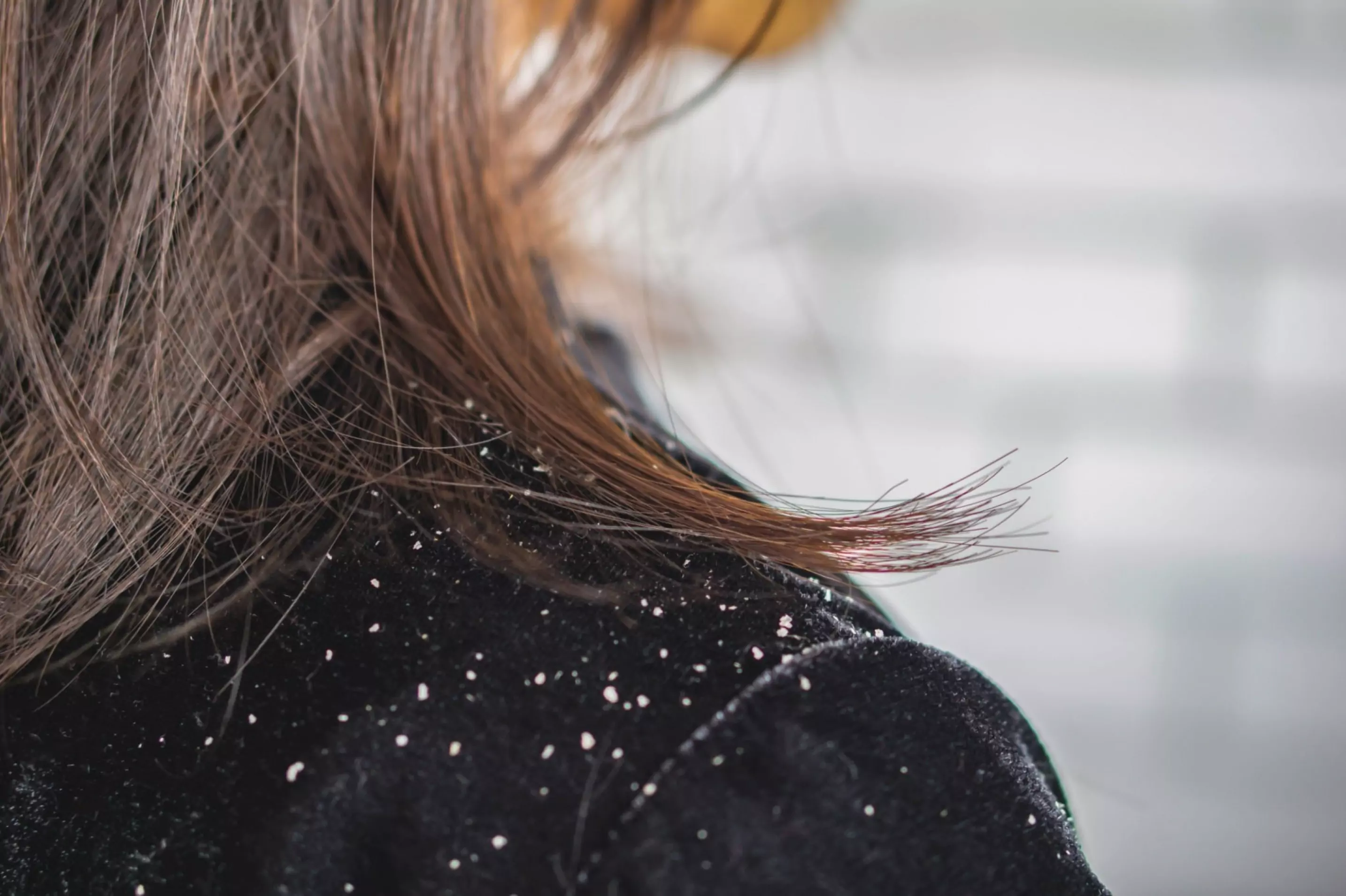 How to deal with Dandruff ?